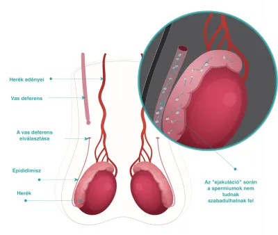 Vazektómia illusztráció – az eljárás menete